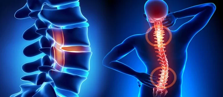 Degenerative Disc Disease