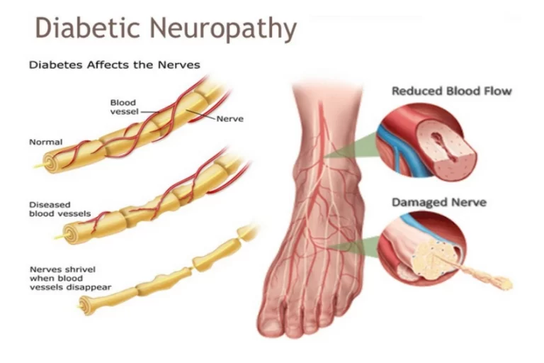 Diabetic-Neuropathy