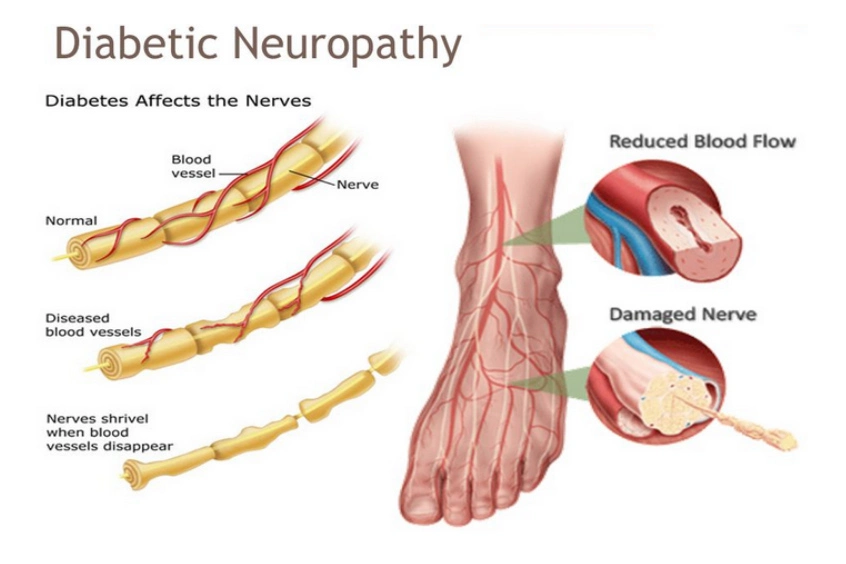 Diabetic-Neuropathy