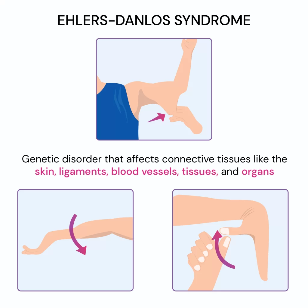 EhlersDanlos Syndrome Cause, Symptoms, Treatment