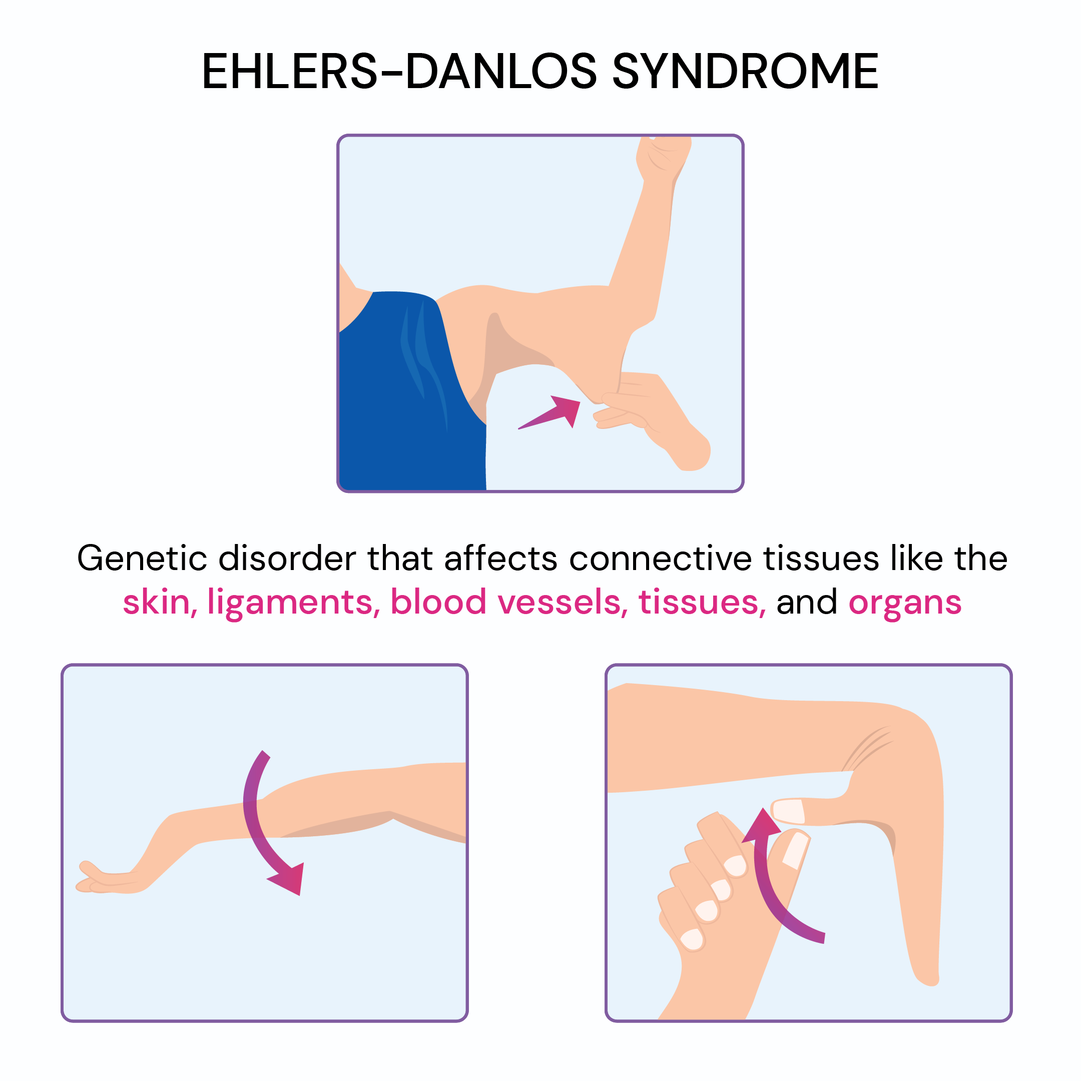 EHLERS-DANLOS-SYNDROME