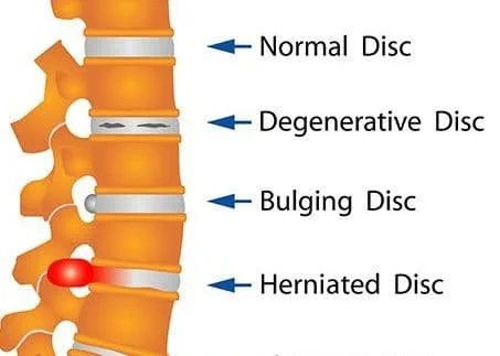 Types and Stages of Disc Herniation