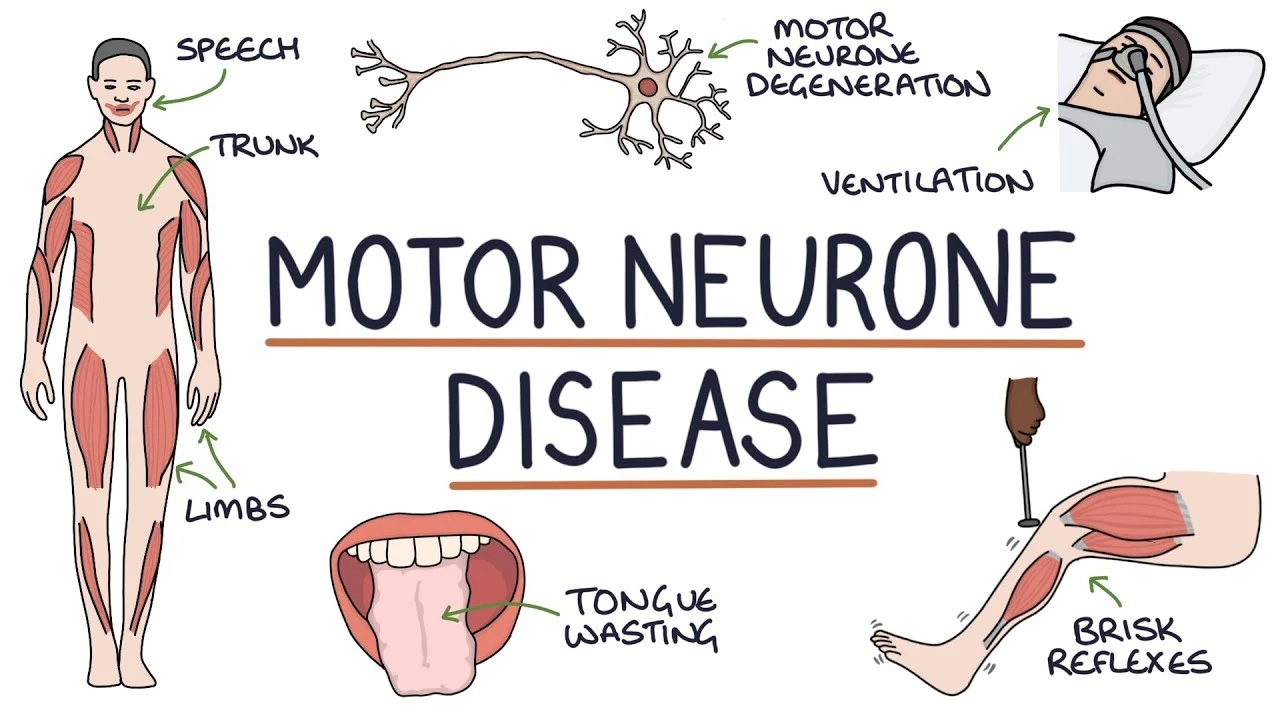 Motor-neuron-disease