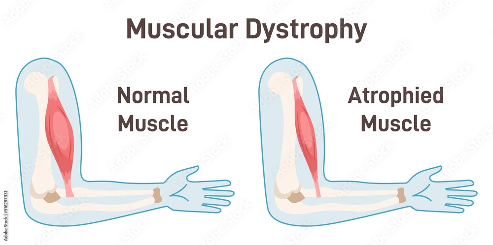 Muscular-Dystrophy
