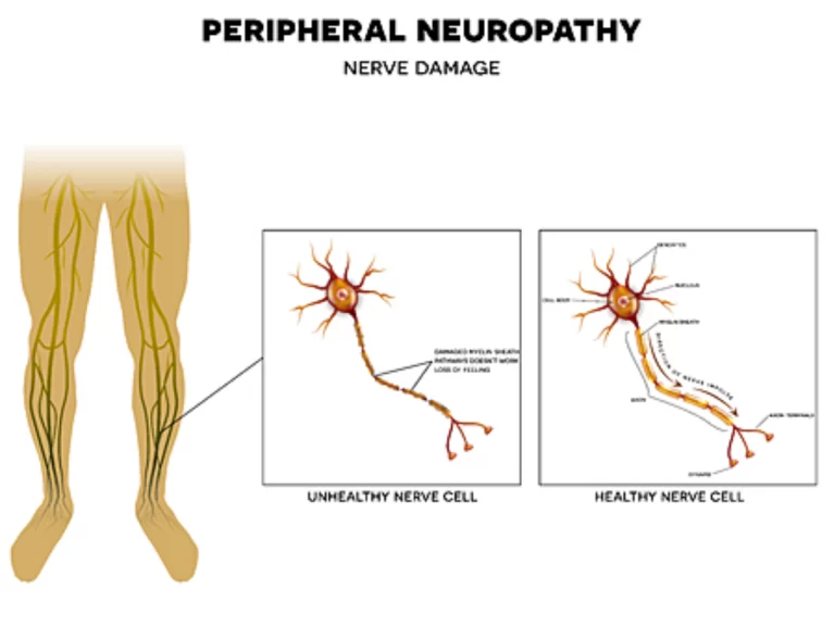 Peripheral Neuropathy