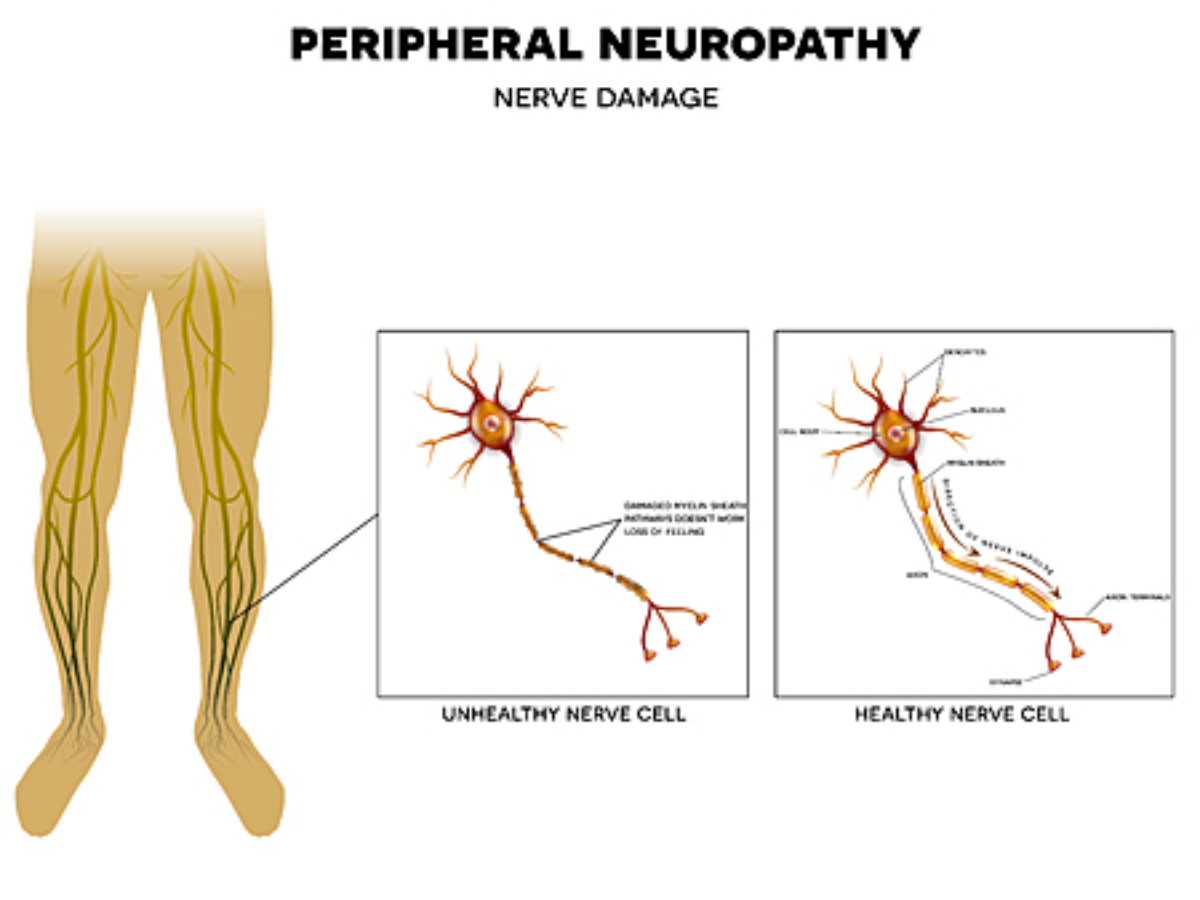 Peripheral-Neuropathy