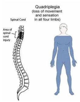 Quadriplegia