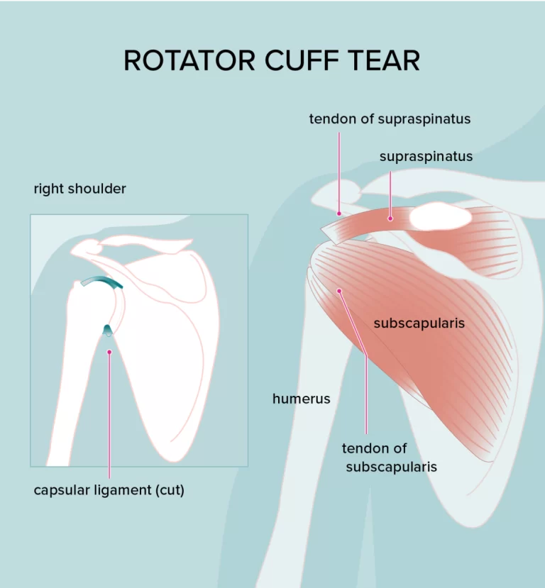 ROTATER CUFF TEAR