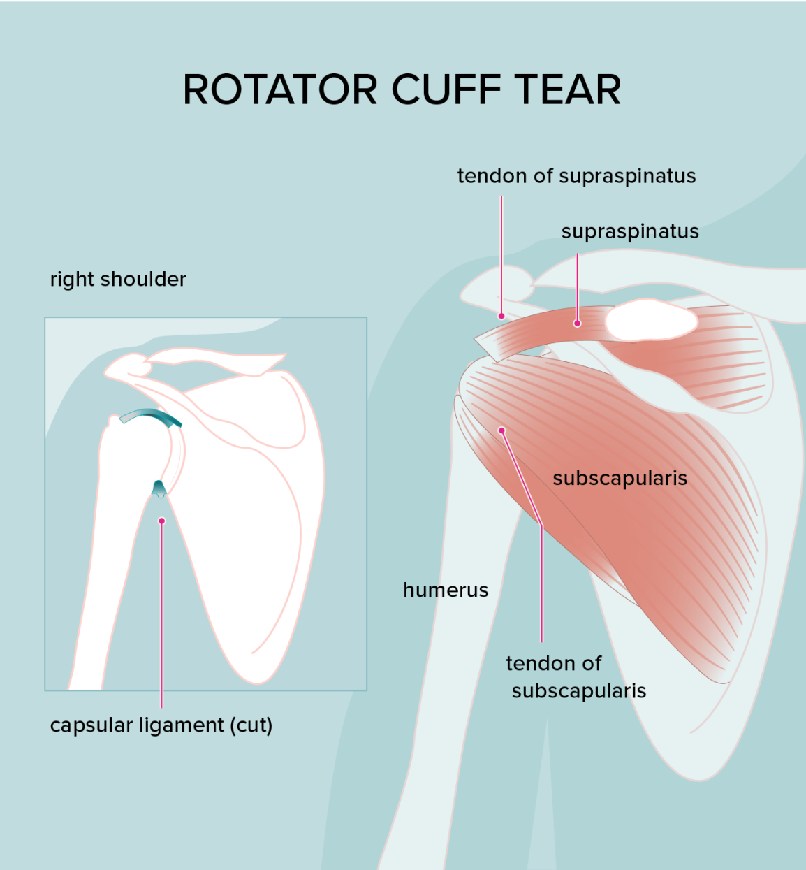 ROTATER CUFF TEAR