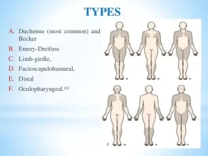 Read more about the article Muscular Dystrophy