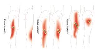 Trigger point in quadriceps