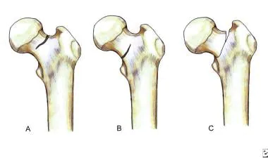 Types of Femoral Neck Fracture