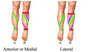 kt-tape-for-shin-splint