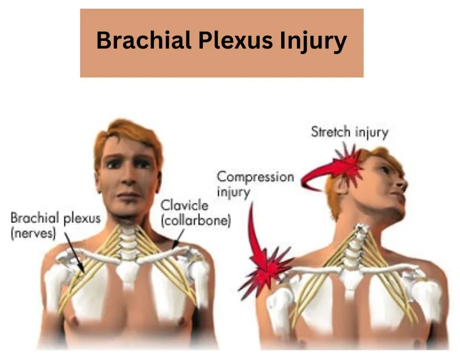 Brachial-Plexus-Injury