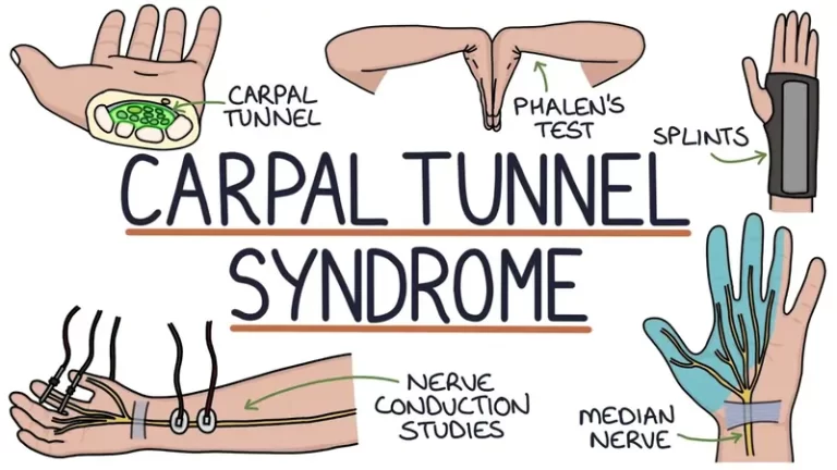 Carpal Tunnel Syndrome