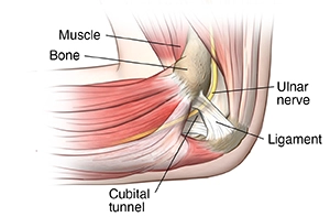 Cubital-tunnel-Syndrome