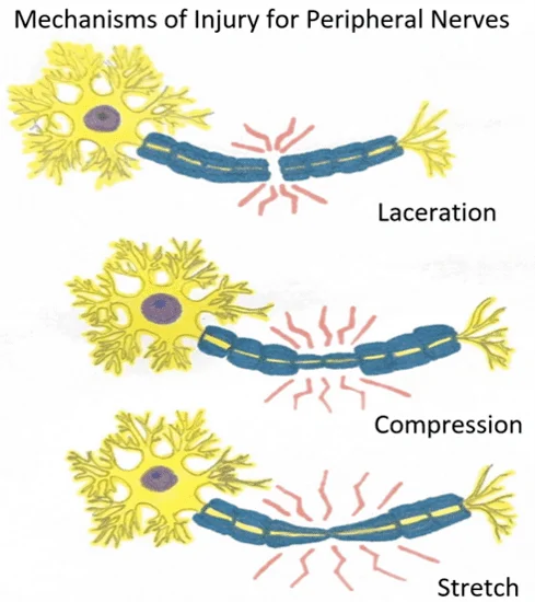 Mechanisms of Injury for Peripheral Nerves