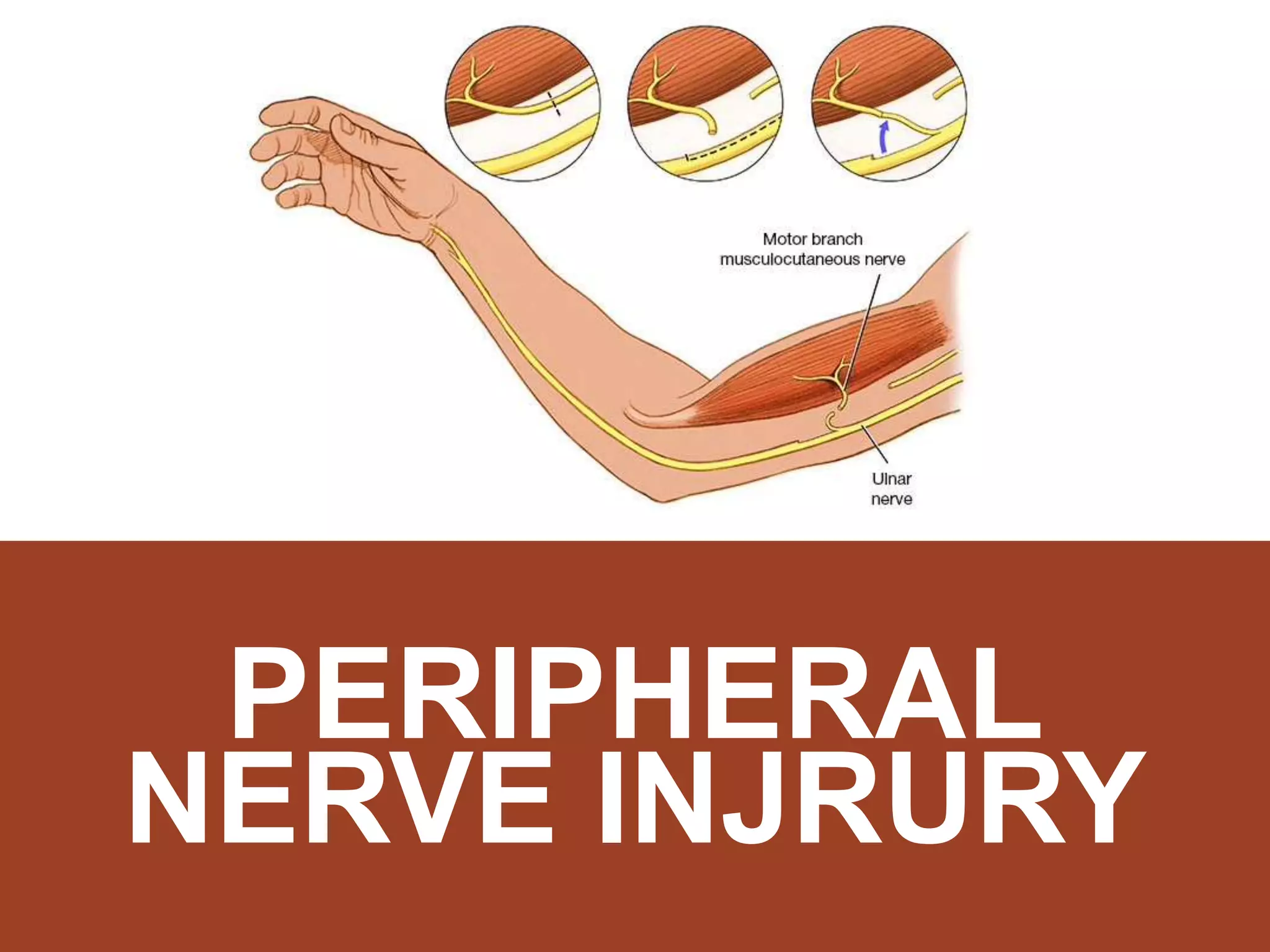 Peripheral nerve injury.