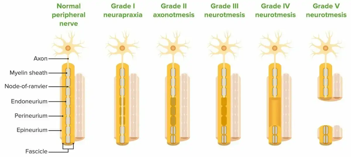 Peripheral Nerve Injury Classifications