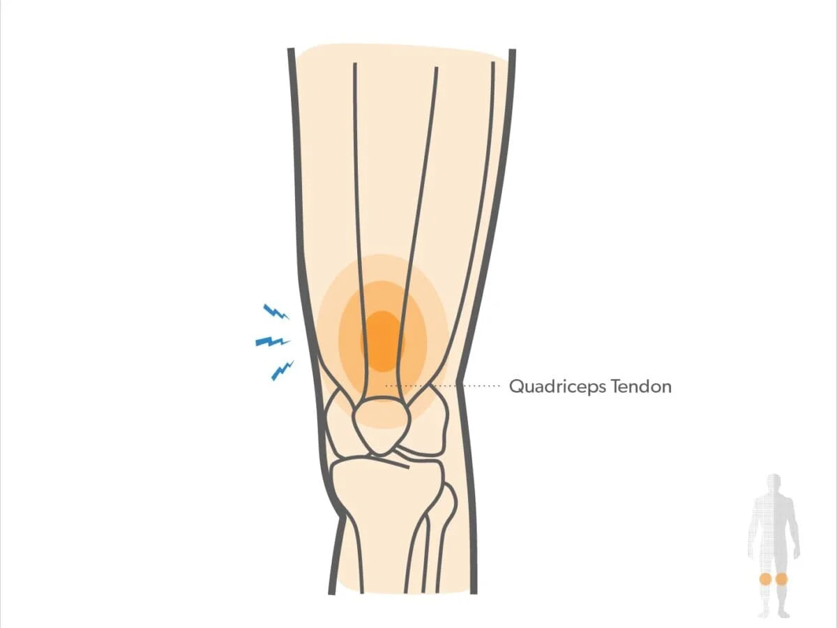 Quadriceps tendonitis