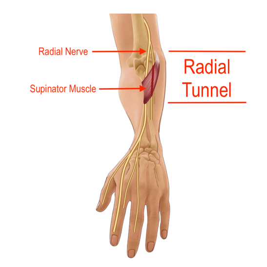 Radial Tunnel Syndrome