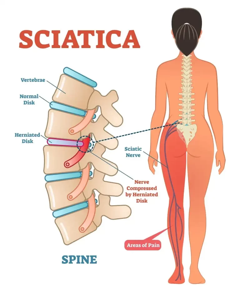 Sciatica