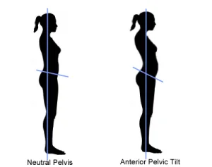 anterior-pelvic-tilt.-image