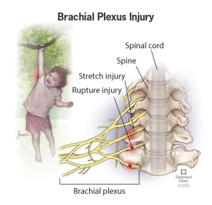brachial plexus injury