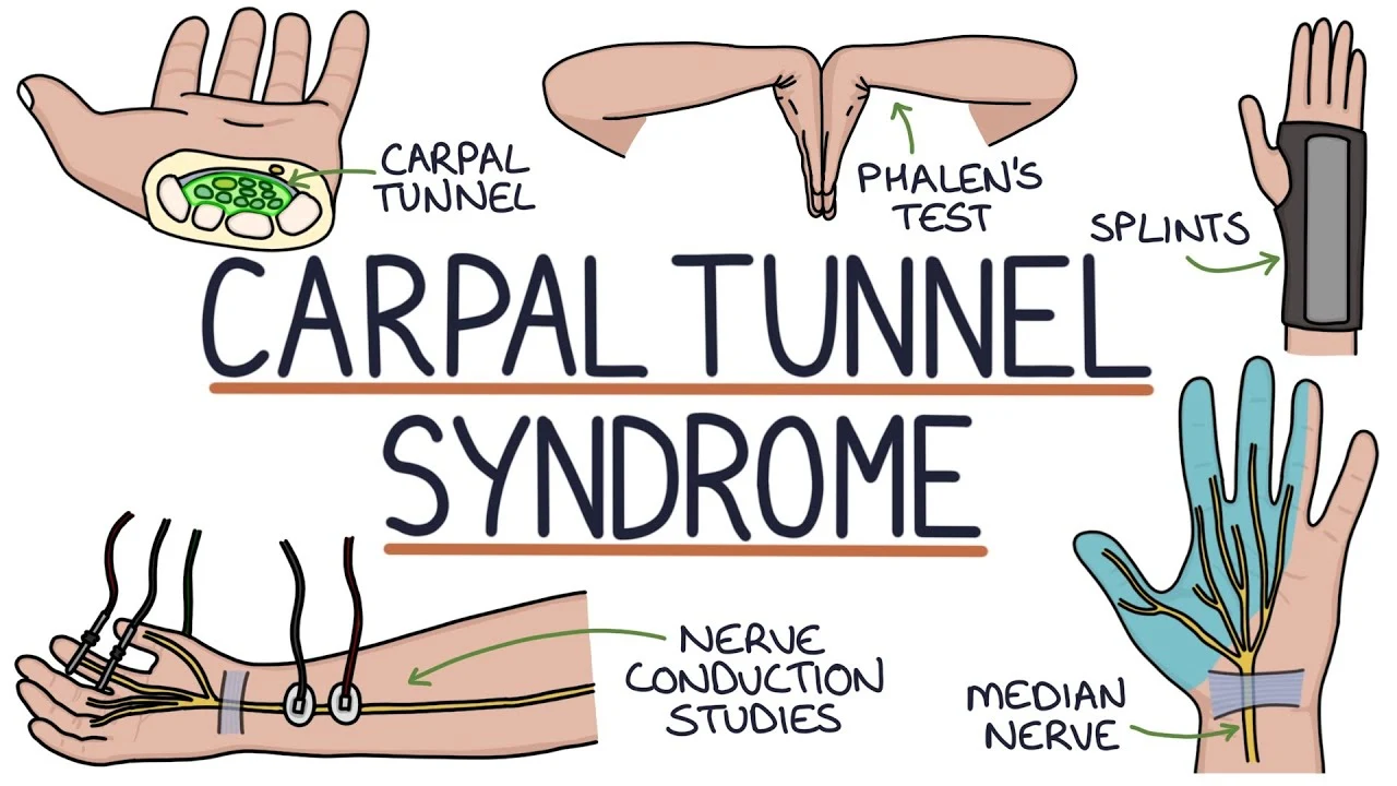 carpal-tunnel-syndrome