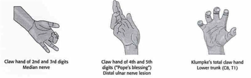 claw hand