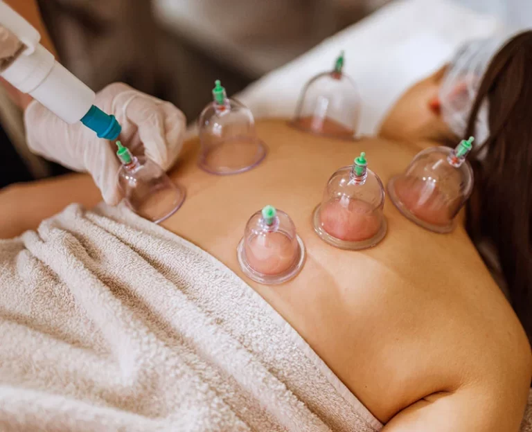 cupping-therapy