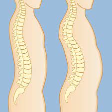 kyphosis images