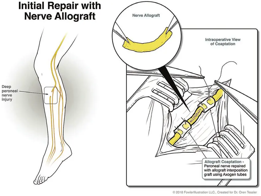 nerve repair and nerve graft