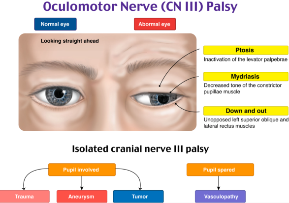 Oculomotor Nerve Palsy
