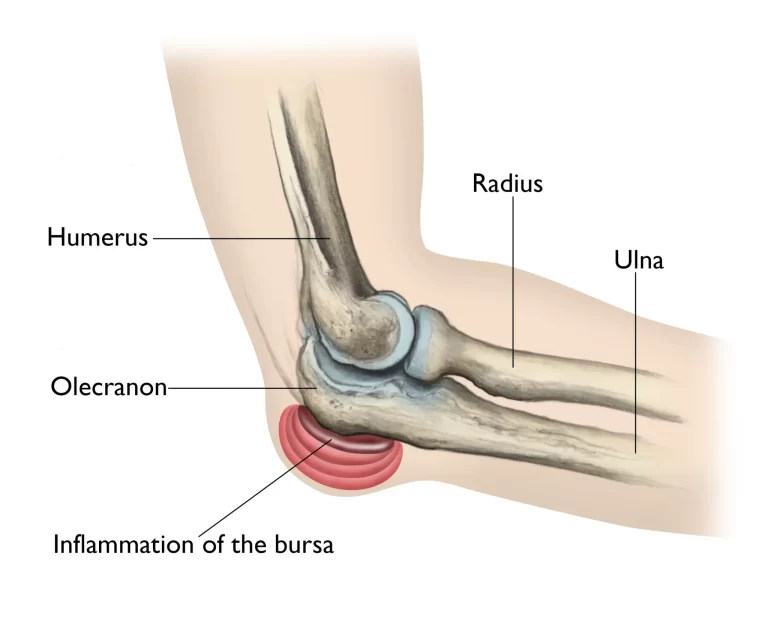 Olecranon Bursitis