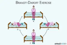 The-Brandt-Daroff-exercise
