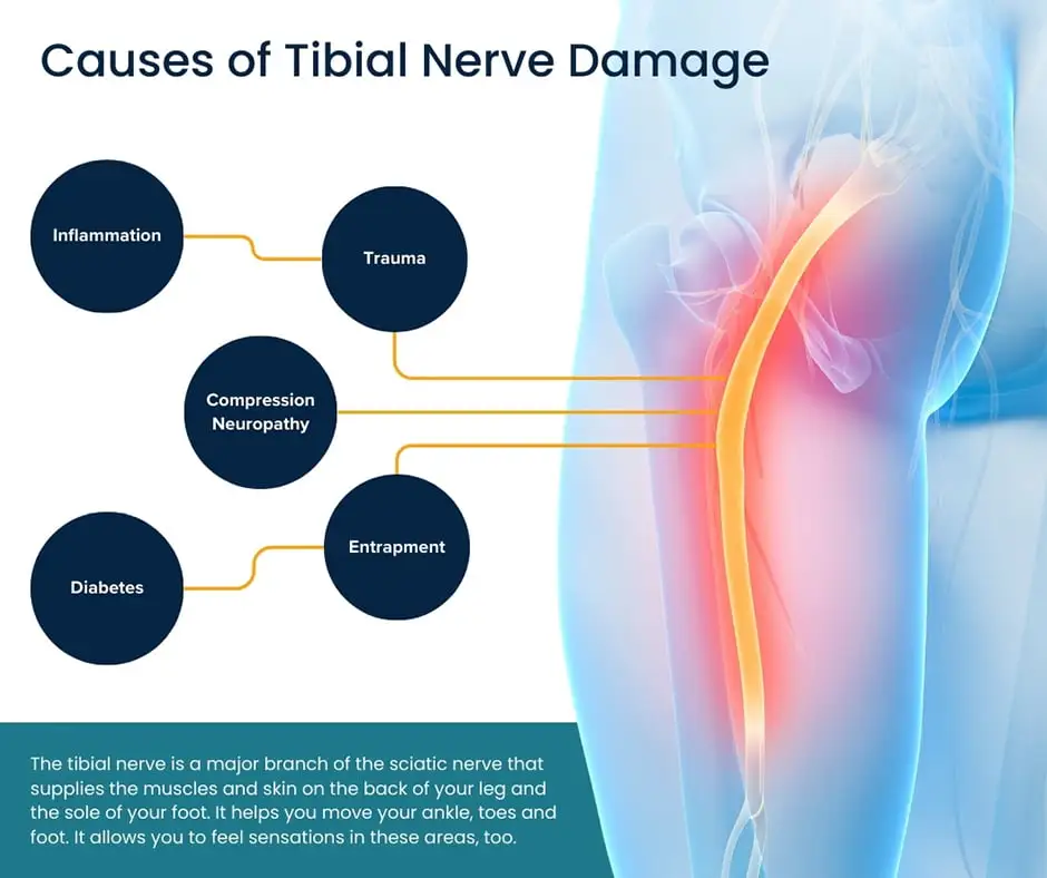 Tibial Nerve Dysfunction