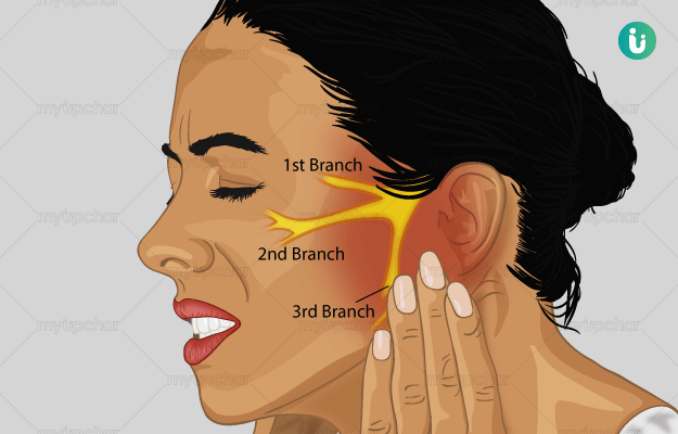 Trigeminal-Neuralgia