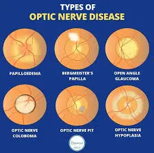 Types-of-Optic-Nerve-Disorders