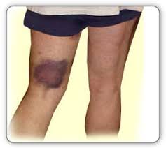 bruises for hamstring injury