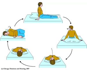 epley maneuver