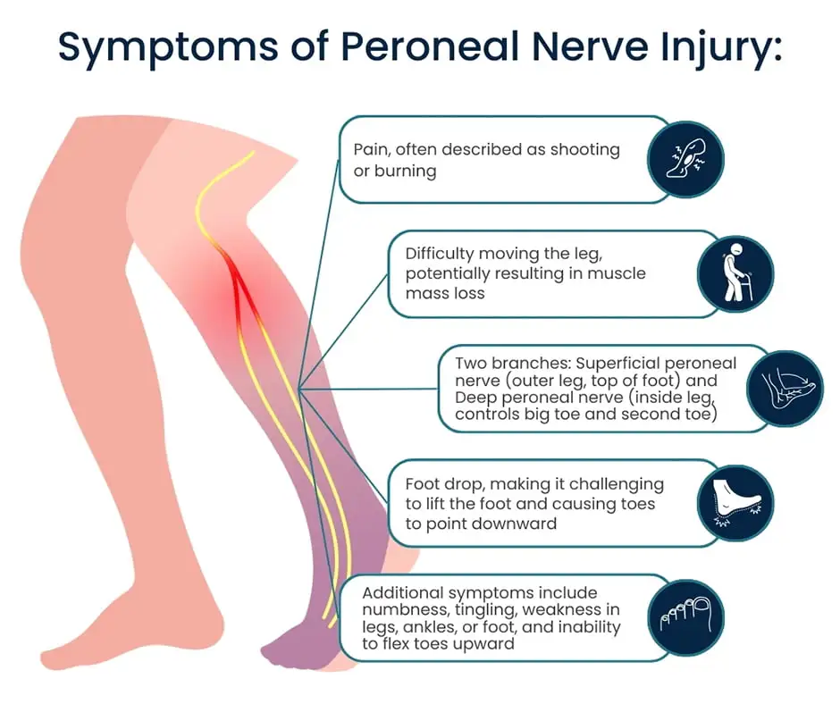 peroneal-nerve-injury
