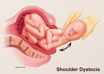 shoulder dystonica