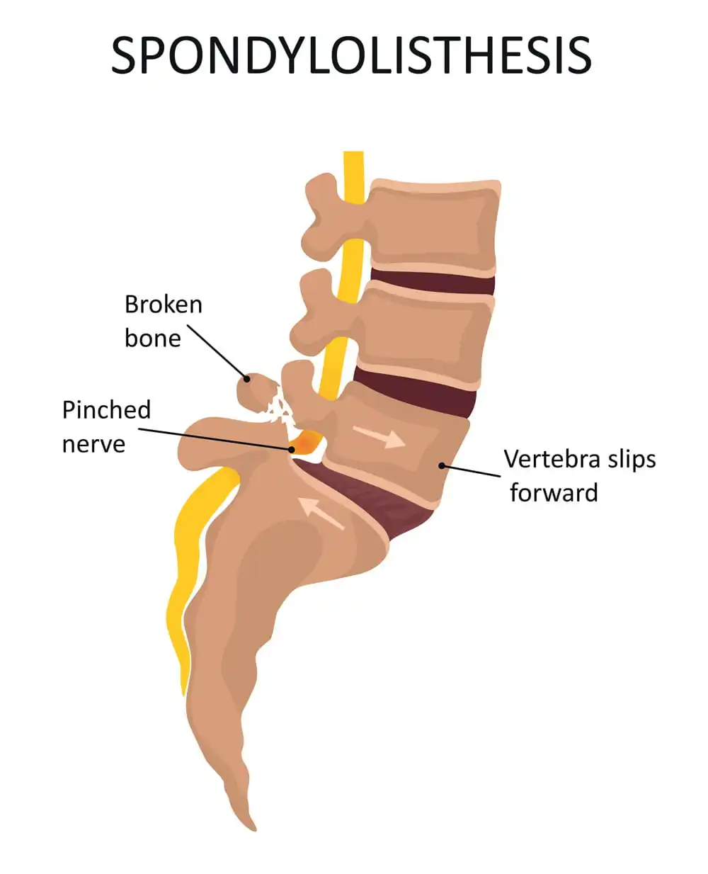 spondylolisthesis