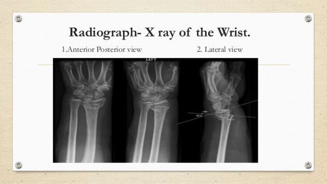 Anterior-Posterior-View-Colles-Fracture