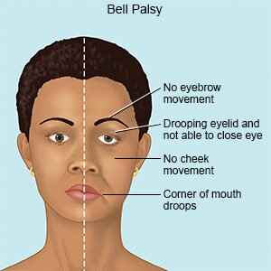 Bell's Palsy: Symptoms, Causes, and Treatment Options