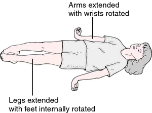 Decerebrate Posture