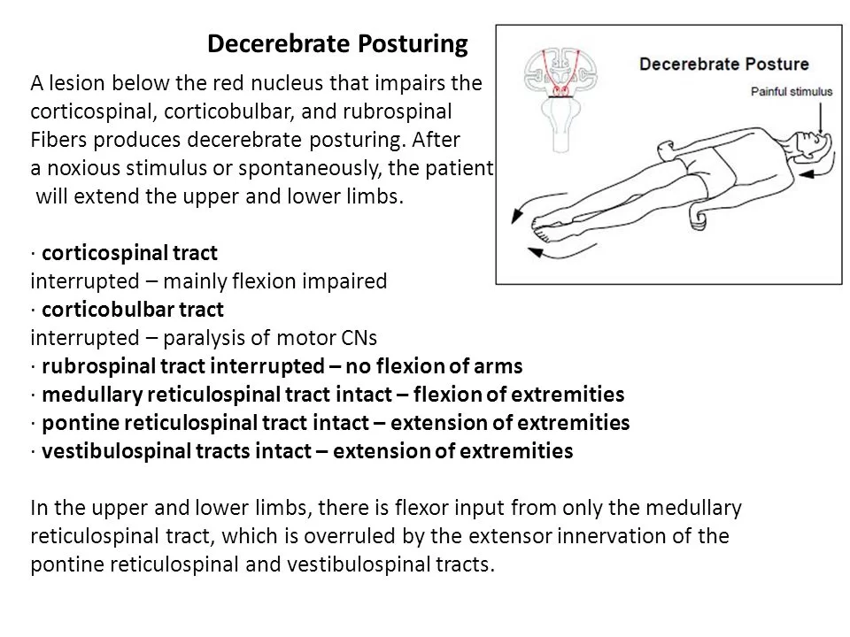 Decerebrate Posturing