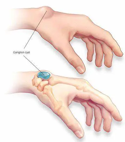 Ganglion Cyst