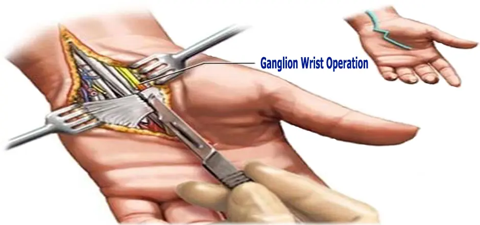 Ganglion-cyst-surgery